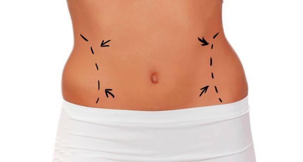 Is Lipo Abdominoplasty suitable after childbirth