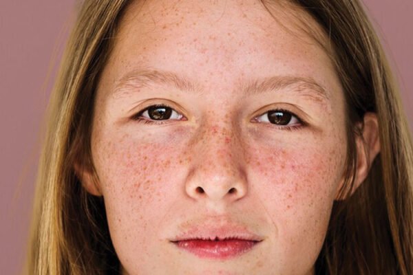 Melasma Treatment Abu Dhabi