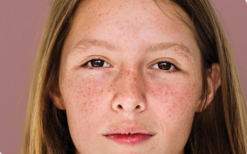 Melasma Treatment Abu Dhabi
