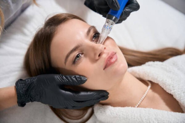 Is Microneedling for Acne Scars Good for Dark Skin
