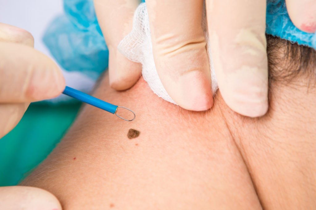 Warts Removal Treatment Abu Dhabi