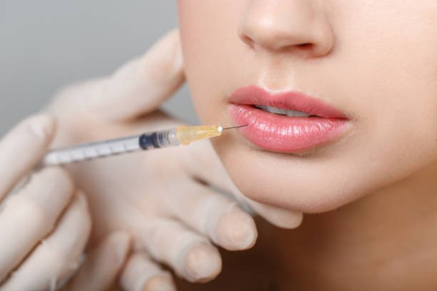 What Is the Ideal Lip Shape With Russian Lip Fillers