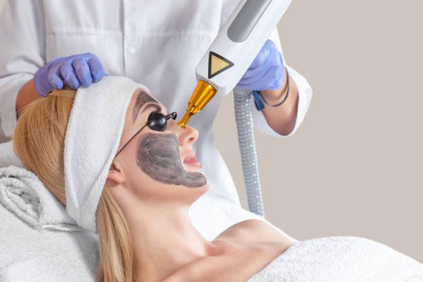 What Makes Laser Carbon Peeling So Popular