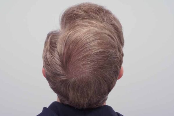 Scarless hair transplant in Abu Dhabi