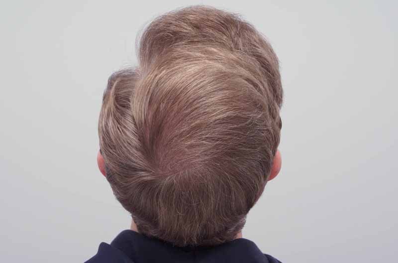 Scarless hair transplant in Abu Dhabi