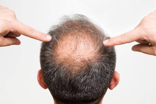 Scalp Micropigmentation Abu Dhabi