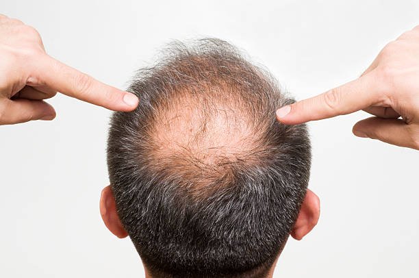 Scalp Micropigmentation Abu Dhabi