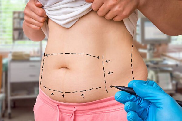 What Results Can You Expect From Tummy tuck Treatment