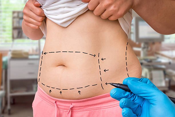What Results Can You Expect From Tummy tuck Treatment