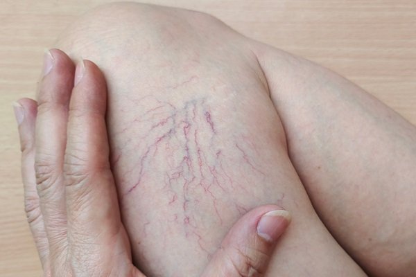 Sclerotherapy Abu Dhabi