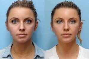 Best Plastic Surgeons in Dubai: Comfortable And Effective Thread Lift Procedures