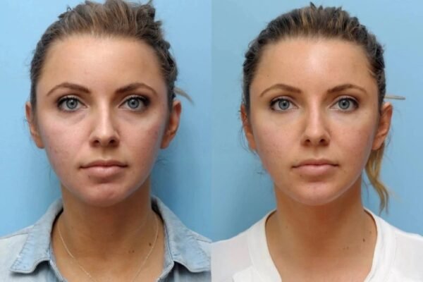 Best Plastic Surgeons in Dubai: Comfortable And Effective Thread Lift Procedures