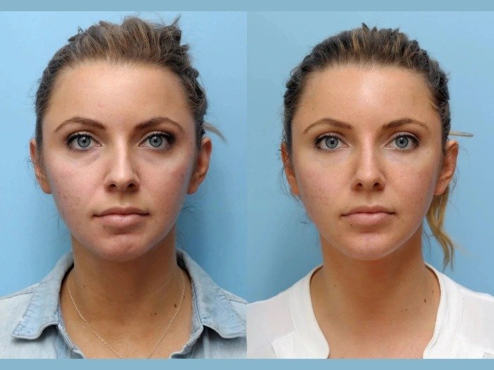 Best Plastic Surgeons in Dubai: Comfortable And Effective Thread Lift Procedures