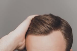 Hair Transplant in Dubai