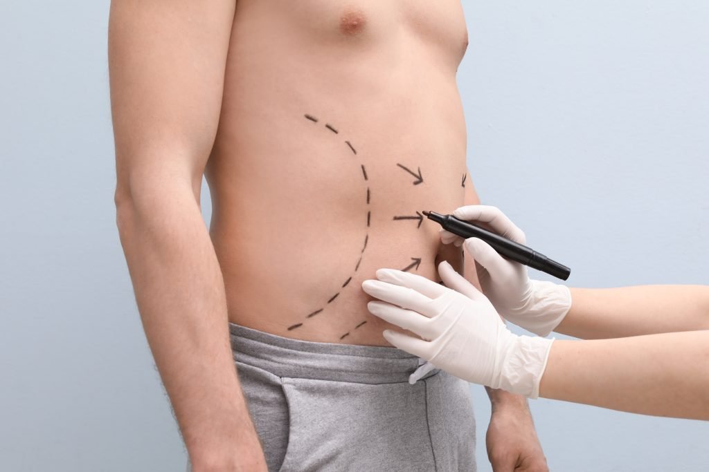 Fat Removal