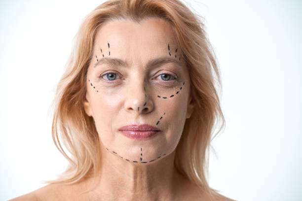 Are Facelifts effective for loose skin beneath the chin