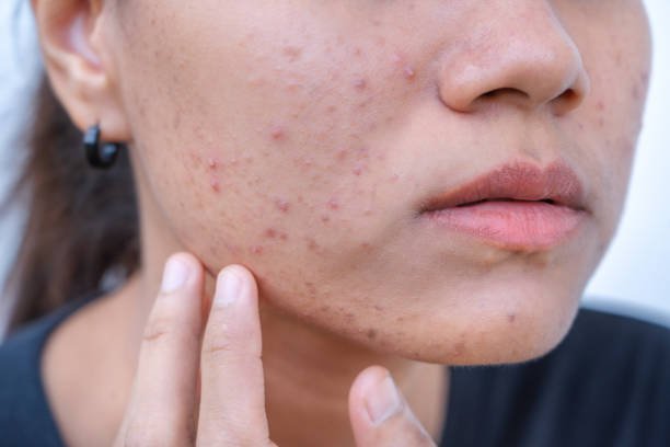 Can Acne Treatment Reduce the Look of Acne Scars