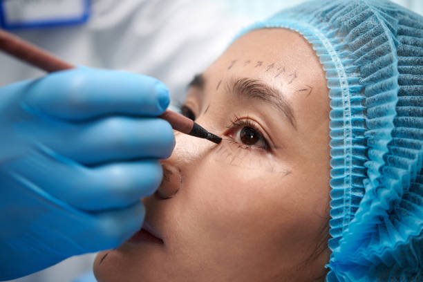 Can Blepharoplasty rejuvenate the area around your eyes