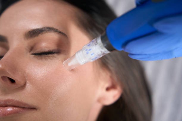 Can Dermapen Microneedling Refresh Tired-Looking Skin