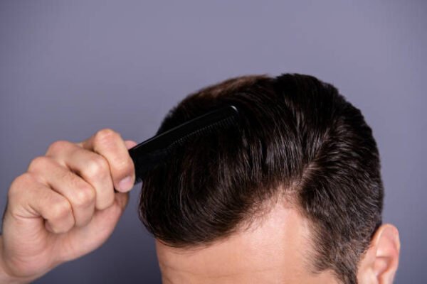 Can FUE Hair Transplant restore thinning temple areas