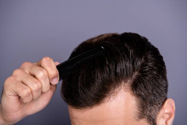 Can FUE Hair Transplant restore thinning temple areas