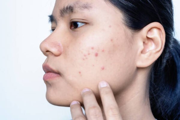 Can Laser Acne Scar Treatment improve uneven skin