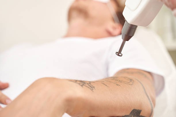 Can Laser Tattoo Removal Fade Tattoo Ink Completely
