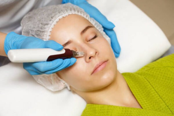 Can Microneedling for Acne Scars reduce scar depth