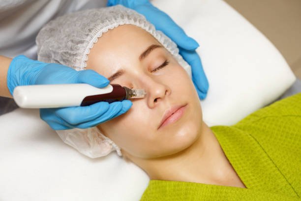 Can Microneedling for Acne Scars reduce scar depth