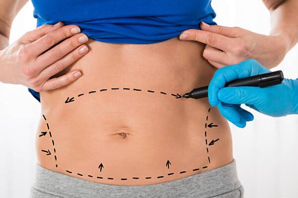 Can Mini Tummy Tuck Improve Your Abdominal Profile