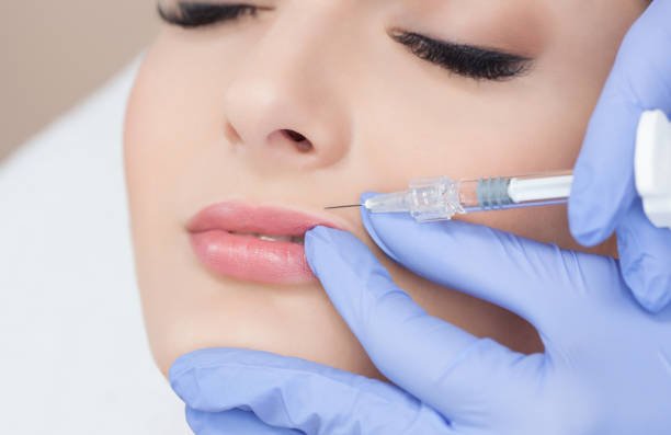 Can Russian Lip Fillers improve upper lip definition