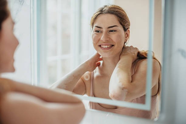 Can Vitiligo Treatment Support a More Even Skin Tone