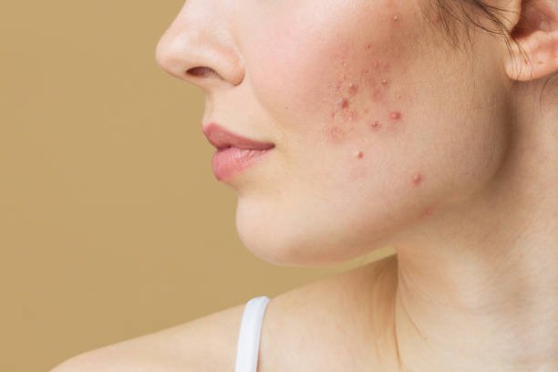 Does Acne Treatment help manage acne around periods