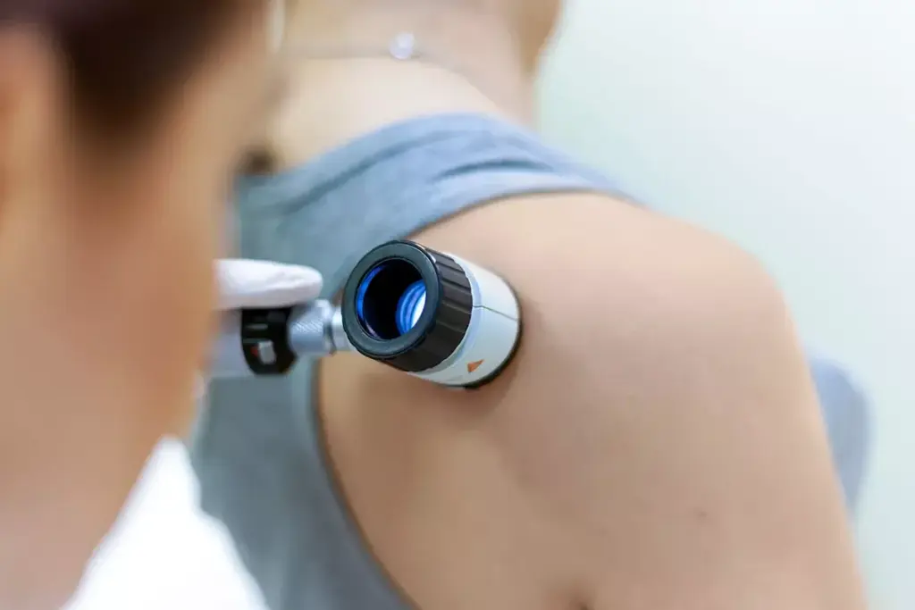 Dermoscopy Mole Evaluation in Abu Dhabi