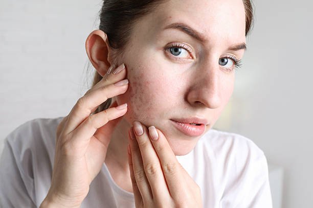 Does Laser Acne Scar Treatment Restore Smooth Skin