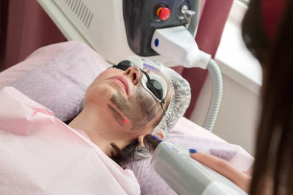 Does Laser Carbon Peel Improve Facial Skin Clarity