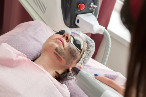 Does Laser Carbon Peel Improve Facial Skin Clarity