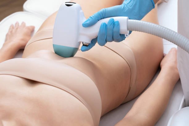 Does Laser Hair Removal require multiple sessions