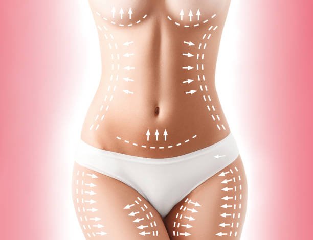 Does Lower Body Lift help improve buttock shape