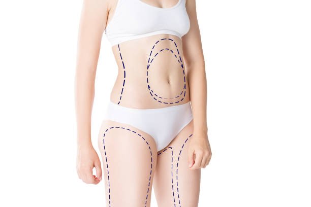 Does Tummy Tuck Surgery require general anesthesia