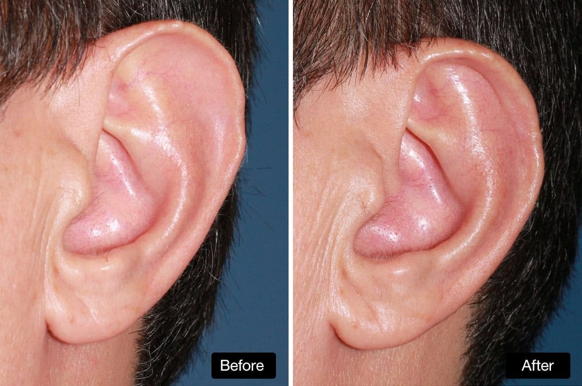 Ear reshaping in islamabad