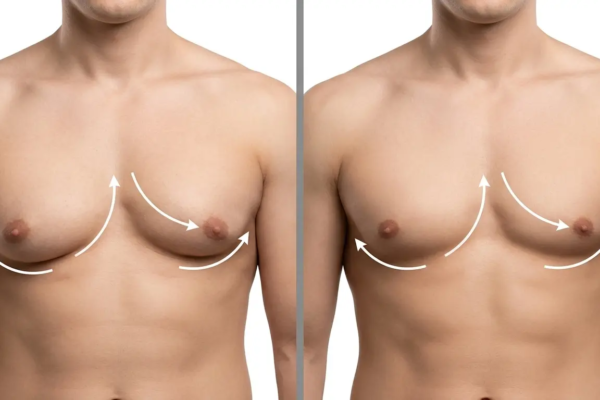 Gynecomastia Surgery Cost