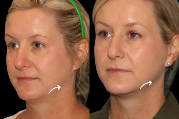 sculptra fillers in dubai