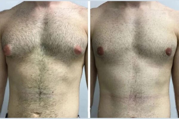 Gynecomastia in Dubai