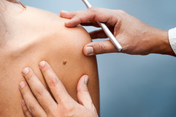 Mole Removal in Abu Dhabi