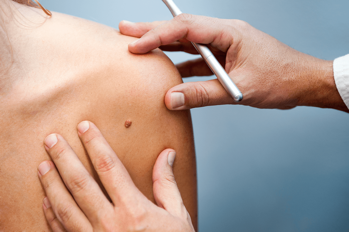 Mole Removal in Abu Dhabi