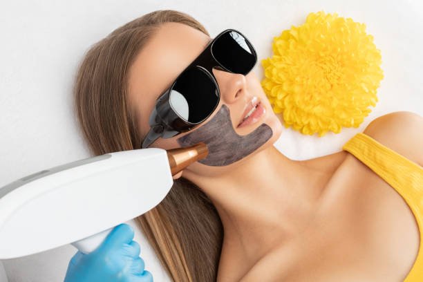 How Does Laser Carbon Peel Treat Congested Skin
