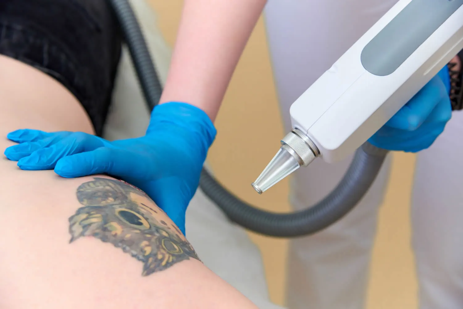 Laser Tattoo Removal in Abu Dhabi