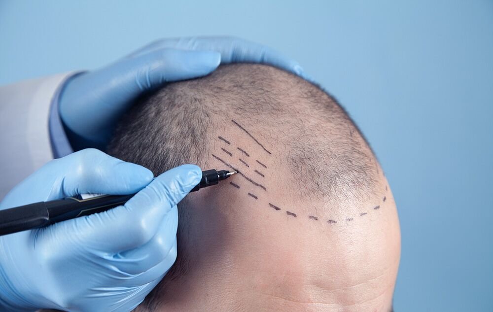 Scalp Micropigmentation Abu Dhabi