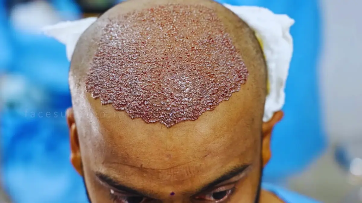 FUE Hair Transplant in Abu Dhabi